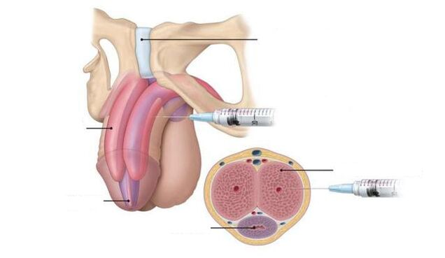 injecții pentru a îmbunătăți potența